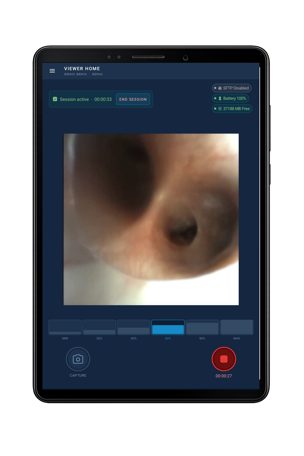 Android tablet running the NETT-Viewer app showing live endoscopic video